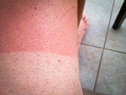 First sunburn of the holiday!